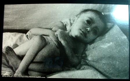 Piccola vittima degli esperimenti del dottor Josef  Mengele, il “dottor morte” di Auschwitz